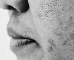 Melasma on Facial Skin