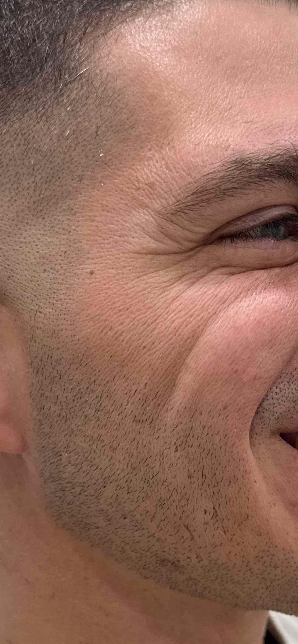 BEFORE COLLAGEN SUPPORT BEFORE COLLAGEN SUPPORT