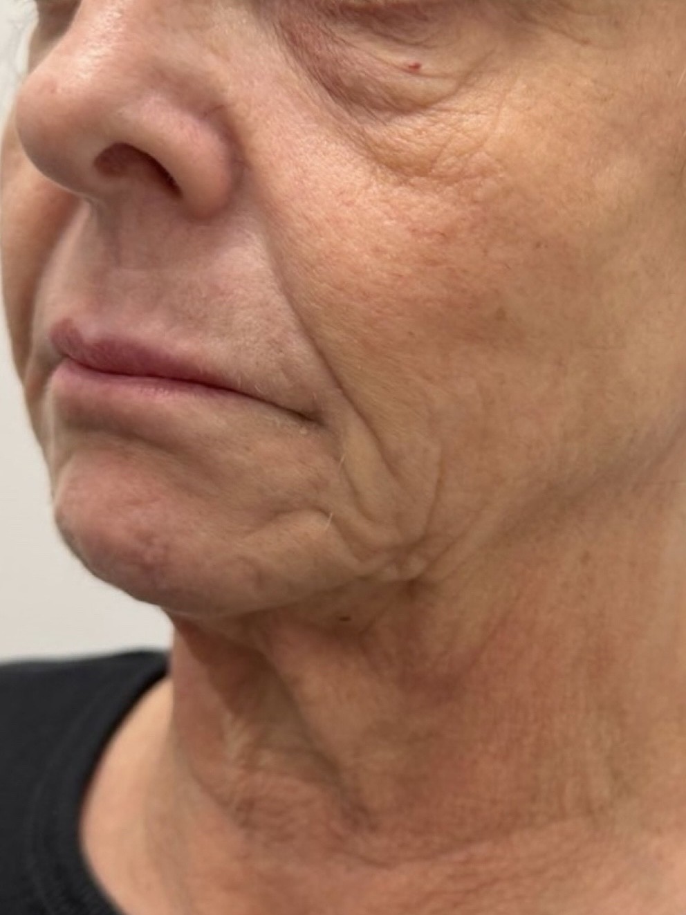 BEFORE TIGHTENING BEFORE TIGHTENING