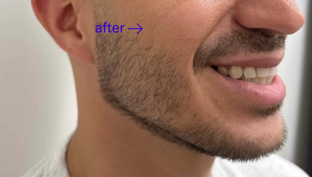 SkinXLULU Collagen loss after