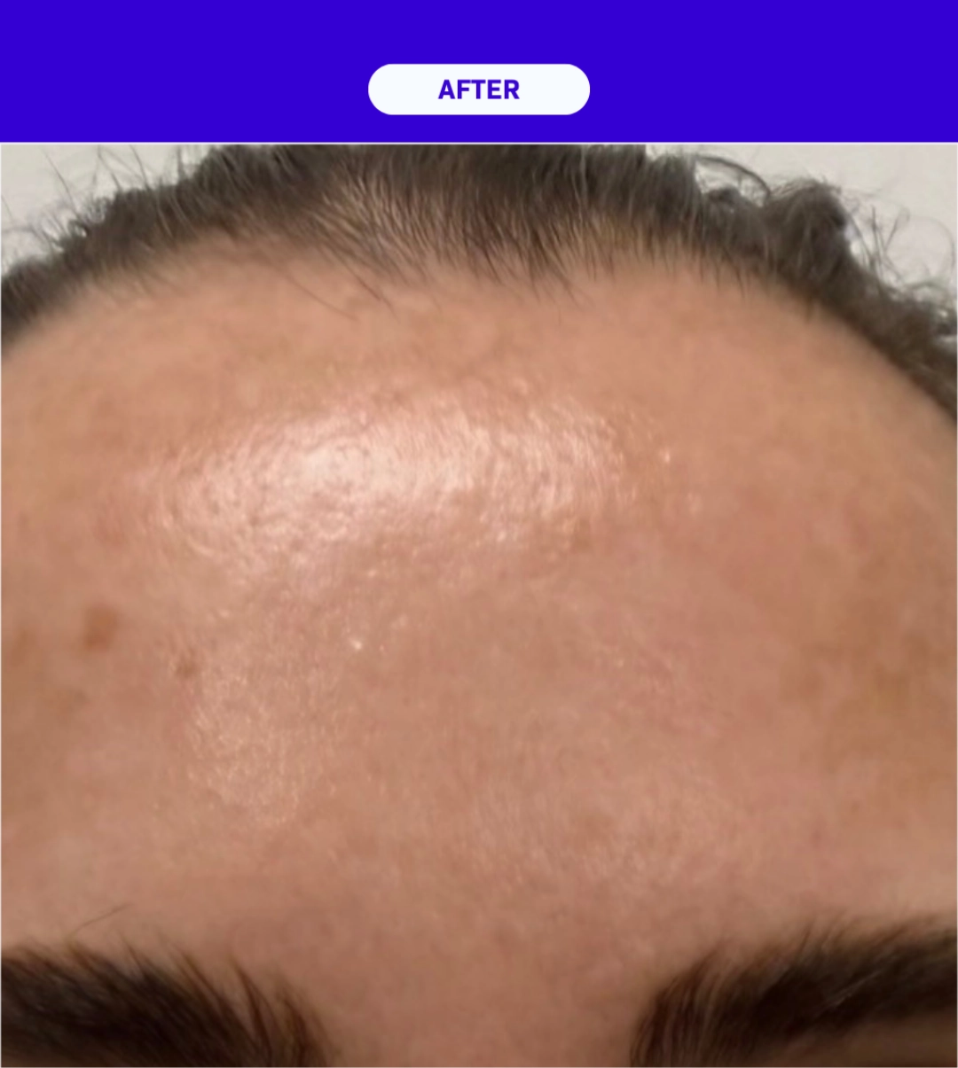SkinXLULU Melasma Treatment After 3 crop
