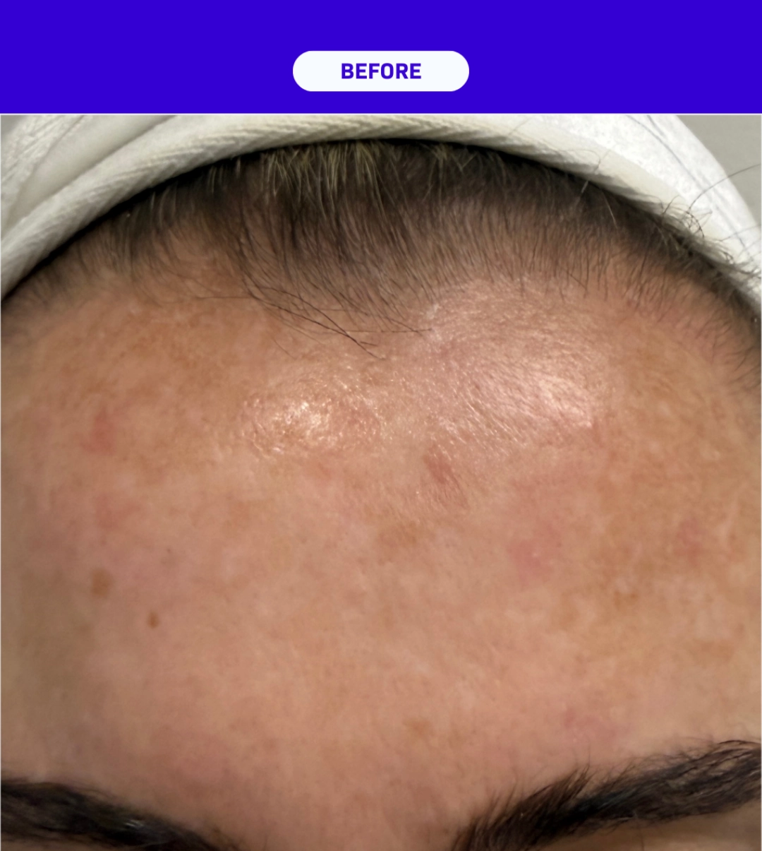 SkinXLULU Melasma Treatment Before 3 crop
