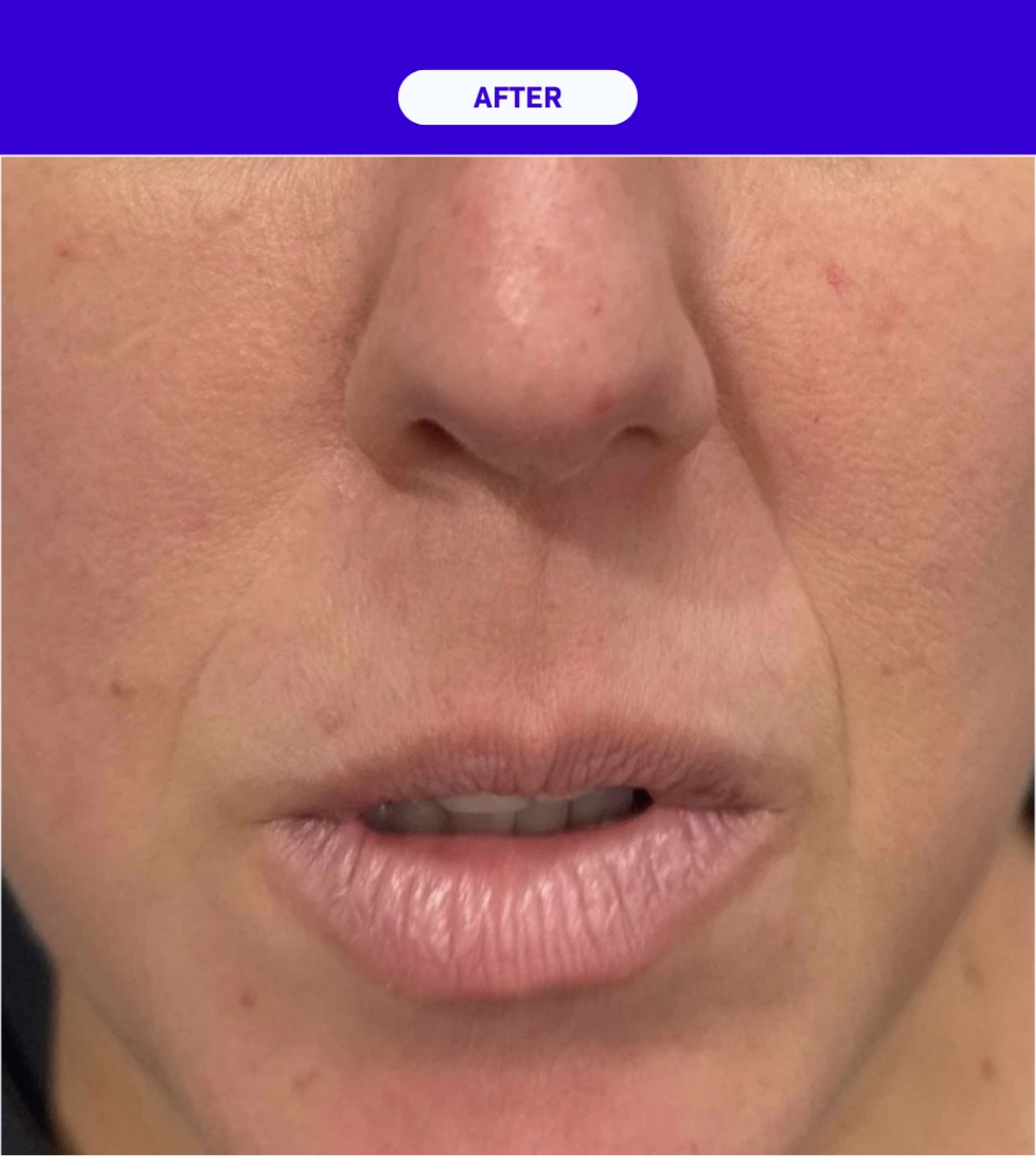 SkinXLULU Rosacea Treatment After 2 crop