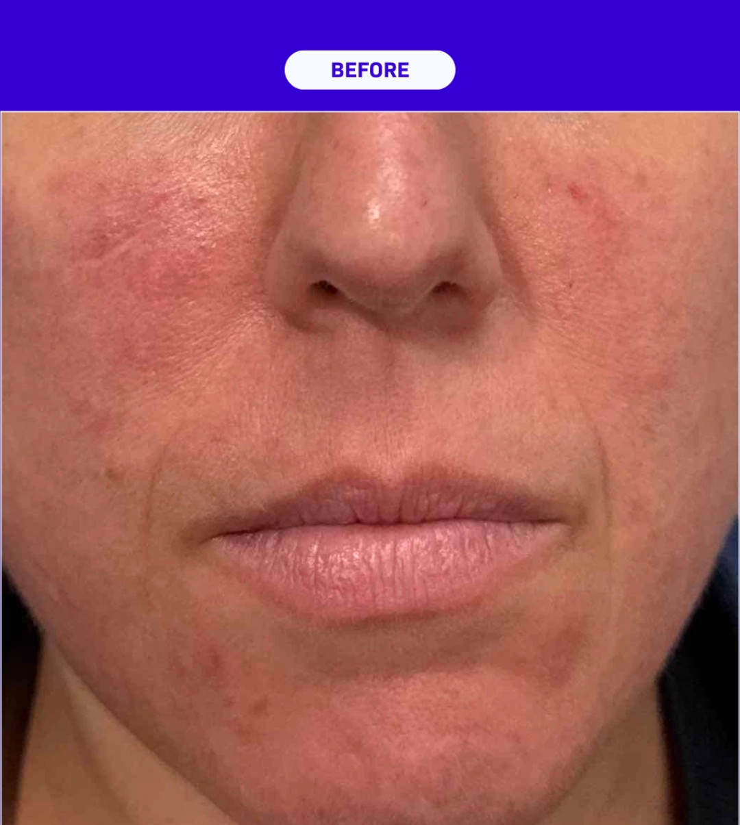 SkinXLULU Rosacea Treatment Before 3 crop