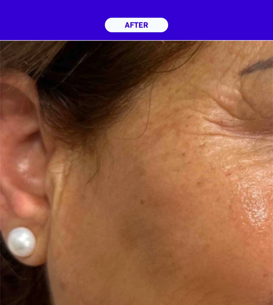 SkinXLulu Collagen Depletion After 3 crop