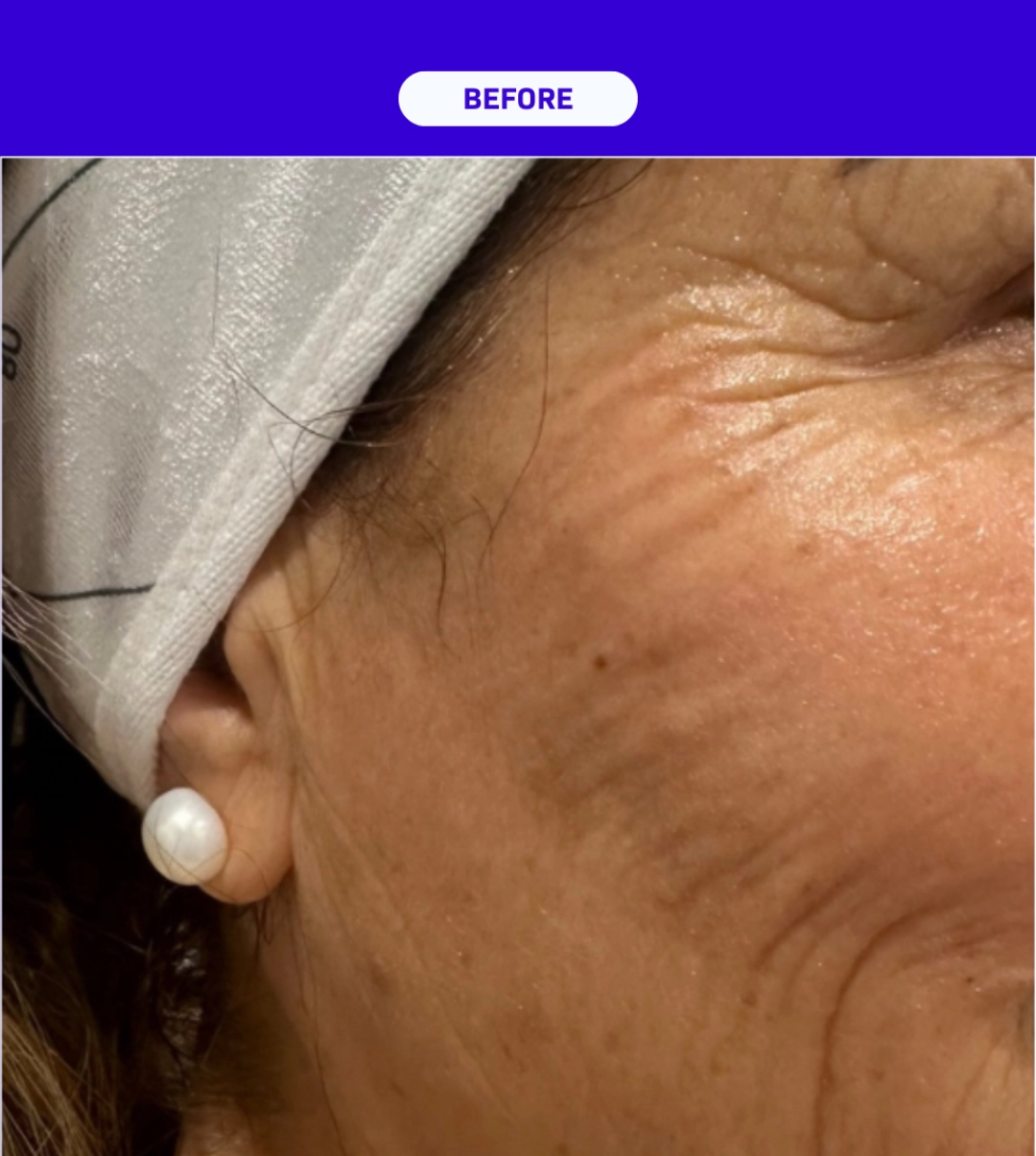 SkinXLulu Collagen Depletion Before 3 crop